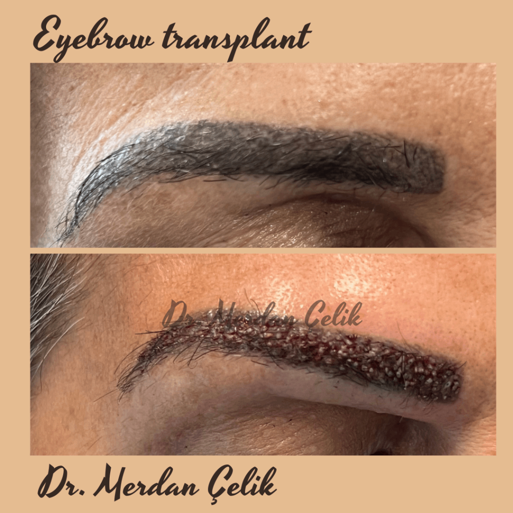 Haartransplantation mit ärztlicher Planung der Augenbraue und medizinischer Betreuung